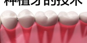 种植牙的条件？ 天津数字化种植牙和传统种植牙区别?