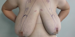 胸大也是病，饱受巨乳困扰的43岁女教师切掉了8公斤！
